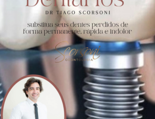Implantes Dentários